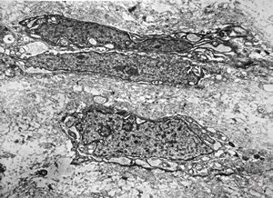 F,12y. | malignant tumor of the orbita - liposarcoma?, neurofibrosarcoma?